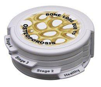 Bone Osteoporosis Disk SetPharmaceutical and Anatomical Model Gifts